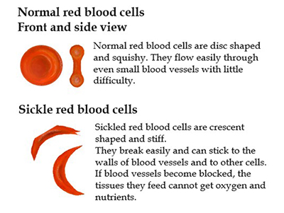 Normal red blood cell vs sickle red blood cell