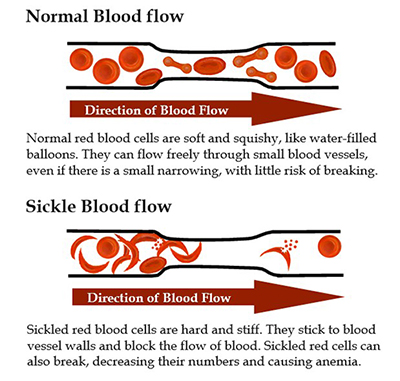 Normal blood flow vs sickle blood flow
